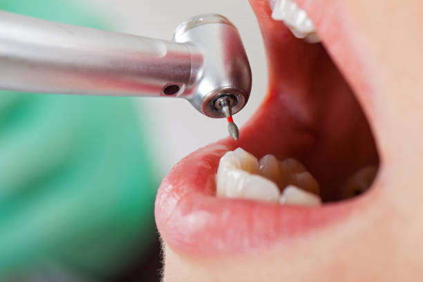 Best Chipped Tooth Repair Near Me  in Hicksville, OH